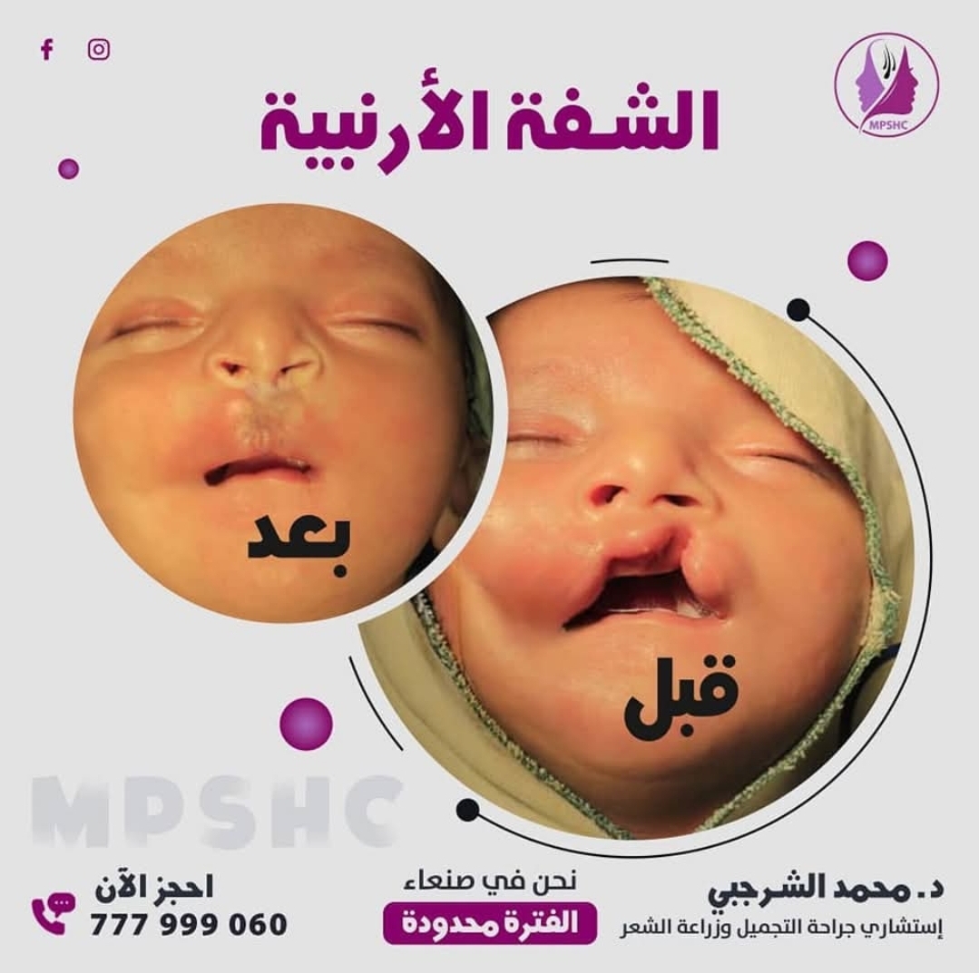  عمليات الشفه الارنبيه